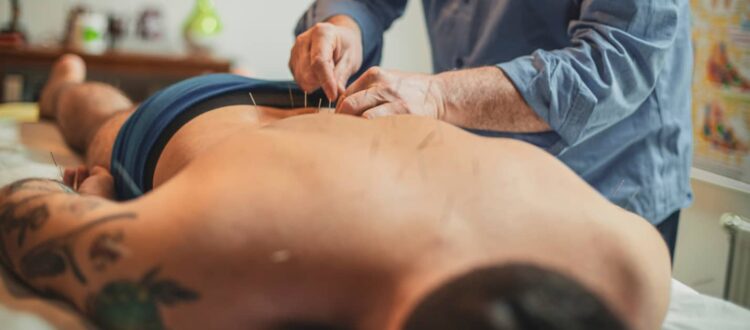 A man lays on a soft table, a practitioner places acupuncture needles in his back.