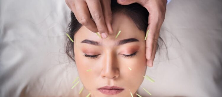 A woman lays on a pillow, a practitioner places acupuncture needles into her forehead.