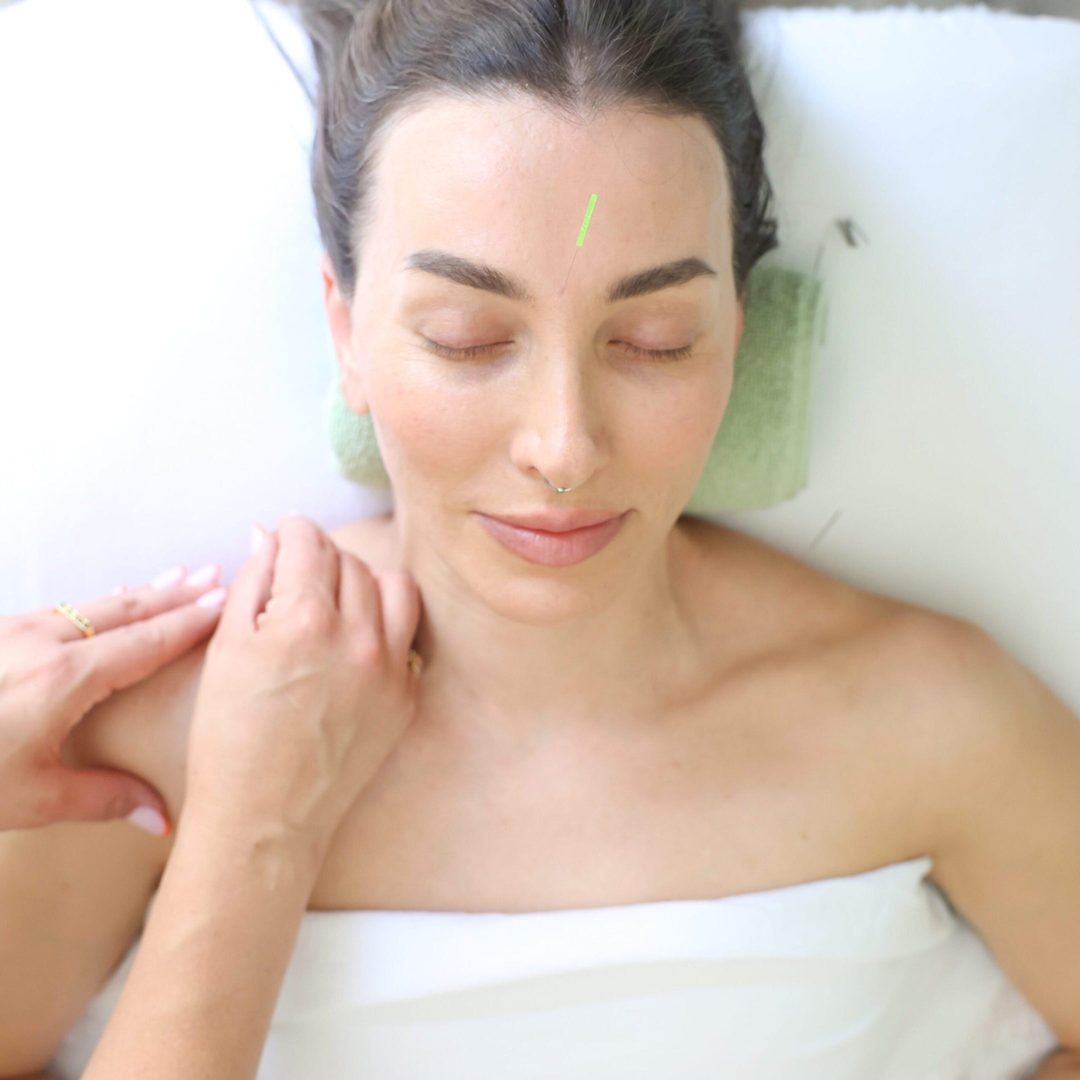 Woman receiving acupuncture and massage therapy.